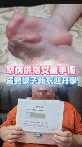 罕病併指女童手術，弱勢學子新衣迎升學封面