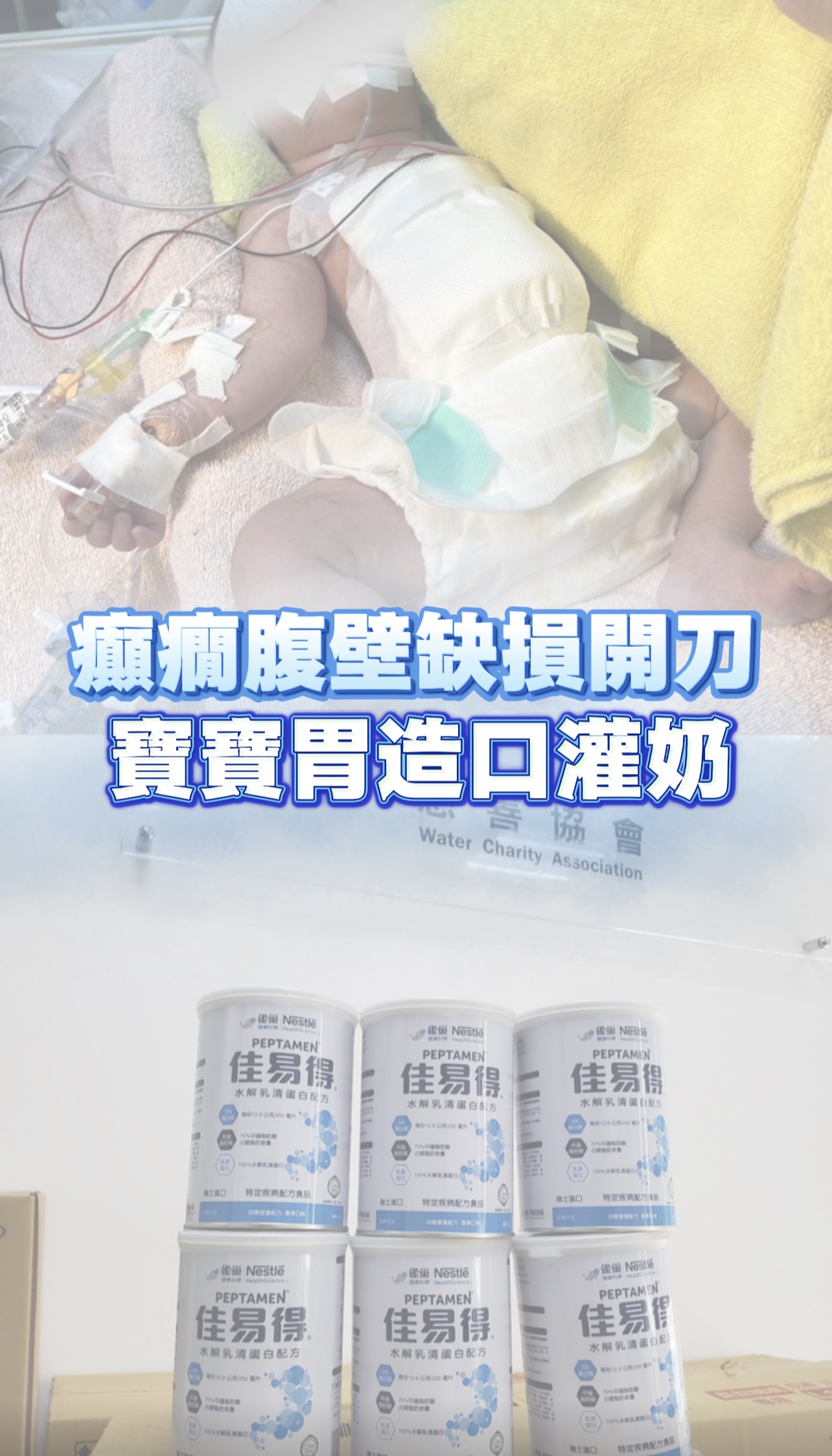 癲癇與腹壁缺損寶寶接受胃造口灌奶及特殊配方奶粉協助